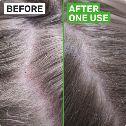 SCALP HEALTH Shampoo Bar